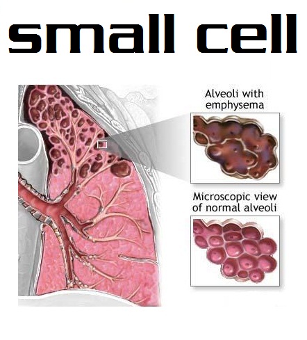 small-cell-lung-cancer.jpg