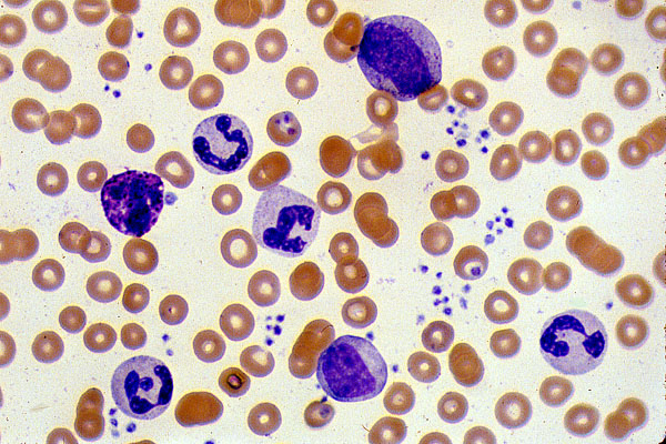 Leukemia Cell Picture Leukemia-cell.jpg