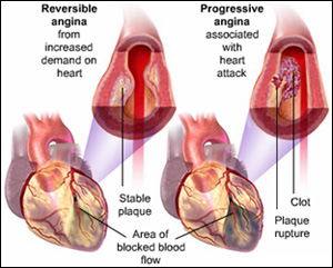 Angina Picture