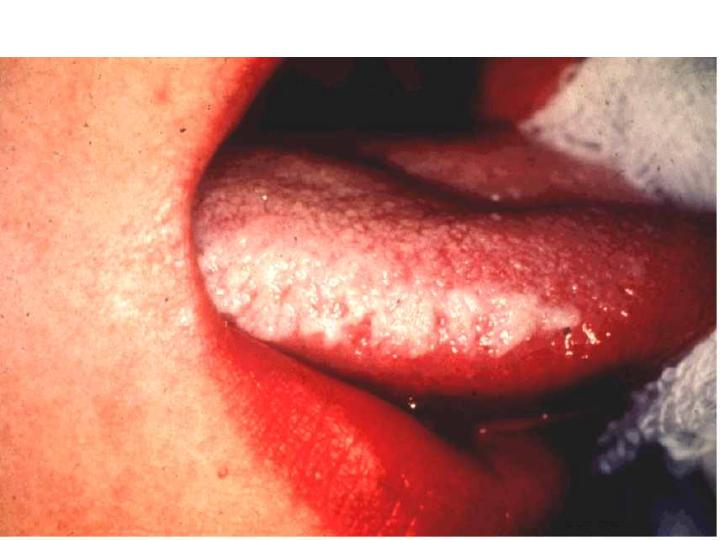 Oral-Hairy-Leukoplakia.jpg