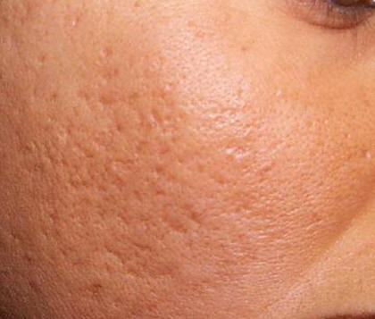 Acne-scar-before.jpg