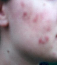 adult-acne.jpg