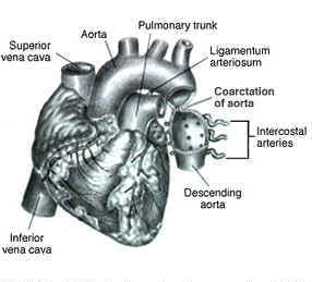 wpe3.jpg (15066 bytes) Coarctation of the aorta