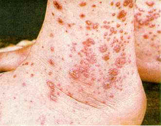 Allergic Vasculitis
