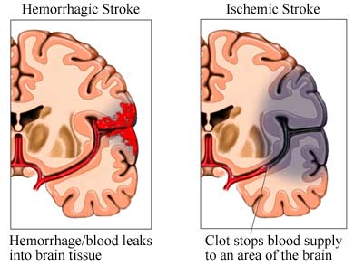 Hemiparesis caused by stroke.